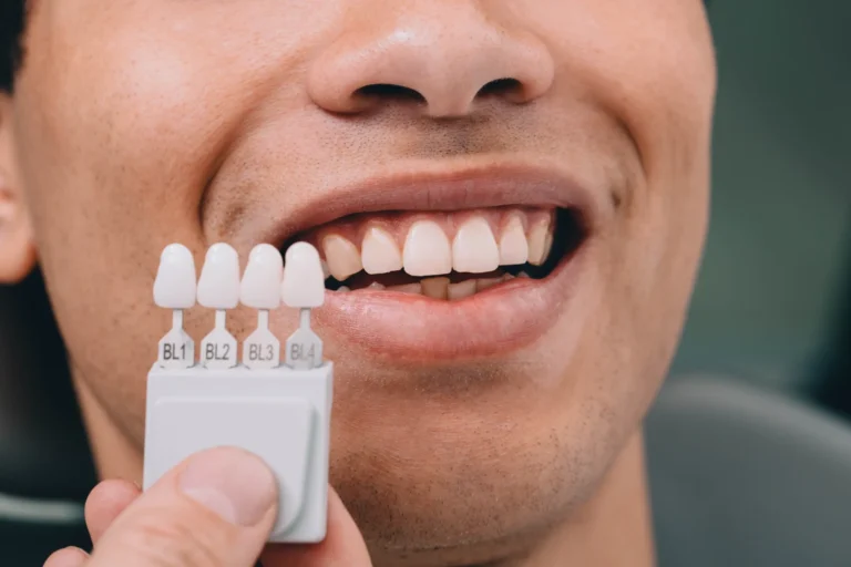 Dental shade guide held beside a patient’s teeth